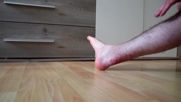 欧洲男子剧痛运动后跟腱断裂手术后跟腱疼痛的愈合过程表明 运动损伤事故后跟腱和踝关节恢复了力量和机动性 — 图库视频影像