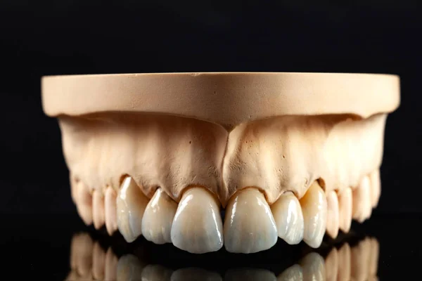 Widok Bliska Ułożenia Zębów Górnej Okleiny Protezy Zębów — Zdjęcie stockowe