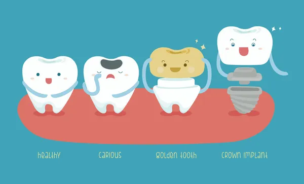 Dente saudável, cariado, dente dourado e implante de coroa dentária —  Vetores de Stock
