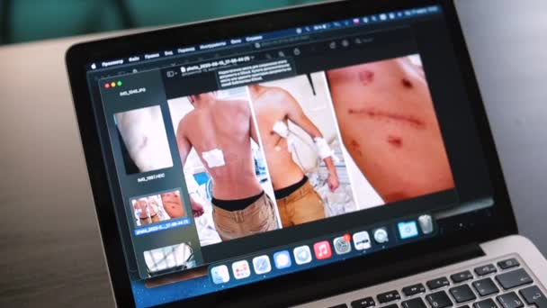 Ukázka obrazovky notebooku. Na obrazovce je muž se zraněními těla. — Stock video