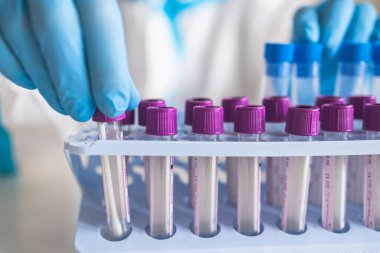 Laboratuvar laboratuarında hemşire doktor tarafından yapılan koronavirüs PCR antijen testi süreci, COVID-19 örnek toplama kiti, OP NP hasta numunesi almak için test tüpü, bir test örneği almak için hasta