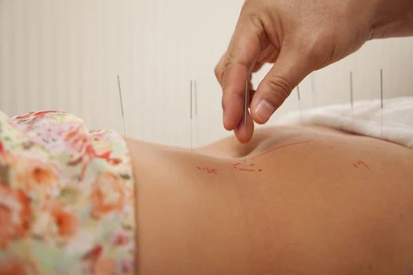 Insertion d'aiguilles d'acupuncture — Photo