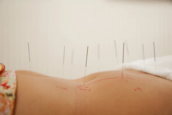 Agulhas de acupuntura na parte central de uma mulher — Fotografia de Stock