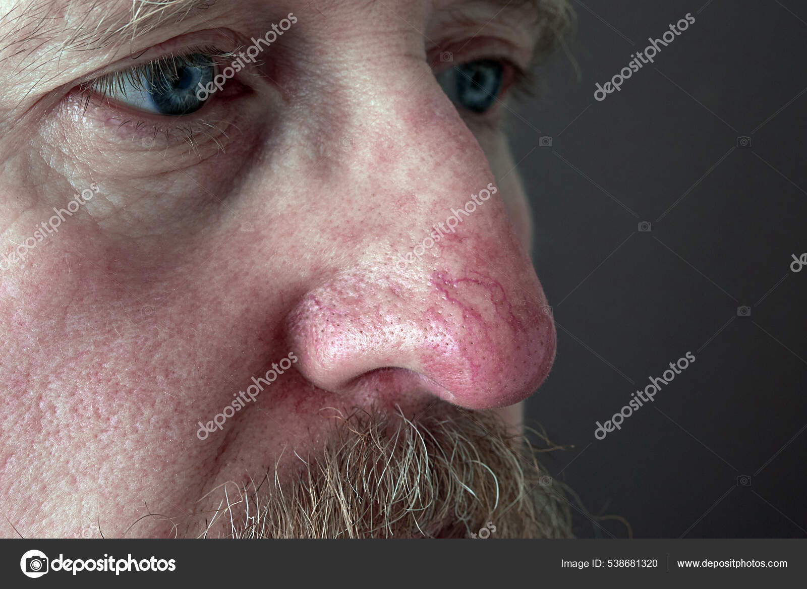 Eczema Nose