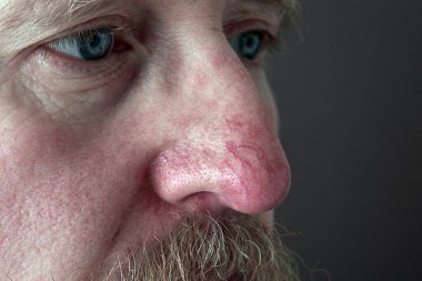 the surface of the skin on the nose in rosacea and eczema clipart