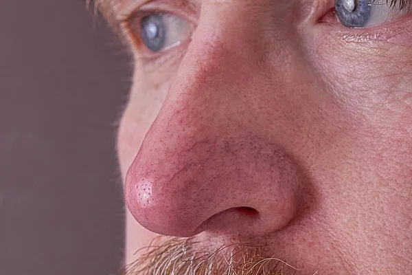 Rosacea ve egzama 'da burnun üzerindeki derinin yüzeyi