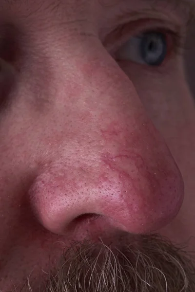 Rosacea ve egzama 'da burnun üzerindeki derinin yüzeyi