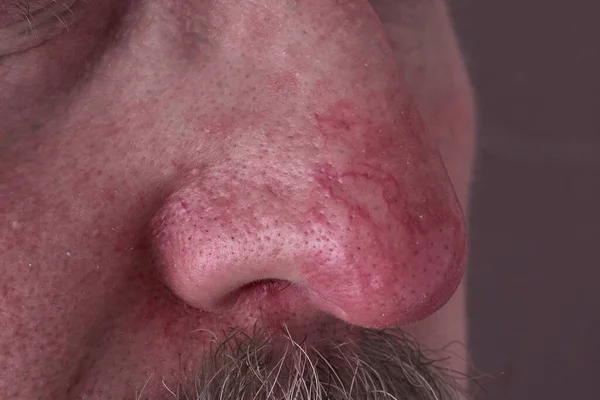 Rosacea ve egzama 'da burnun üzerindeki derinin yüzeyi