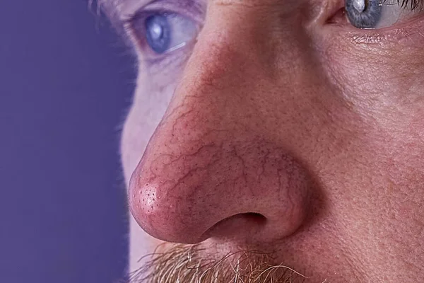 Rosacea ve egzama 'da burnun üzerindeki derinin yüzeyi