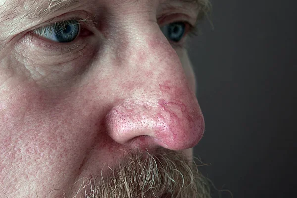 Rosacea ve egzama 'da burnun üzerindeki derinin yüzeyi