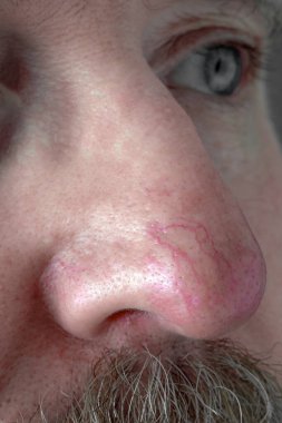 Rosacea ve egzama 'da burnun üzerindeki derinin yüzeyi