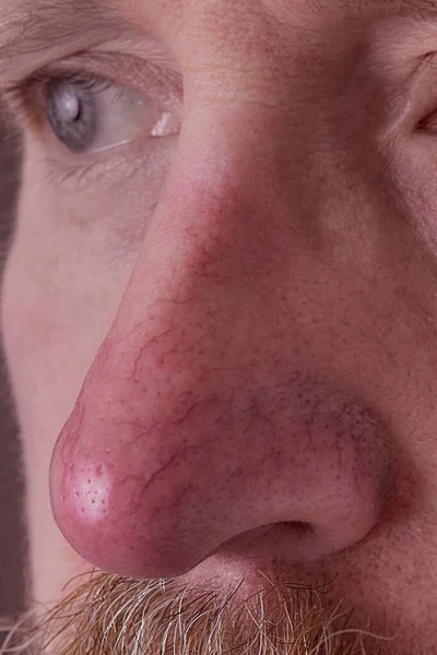 Rosacea ve egzama 'da burnun üzerindeki derinin yüzeyi