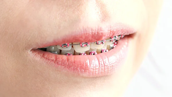 Fogak fogszabályozó, gyönyörű női mosoly, fogászati ellátás fogalma — Stock Fotó