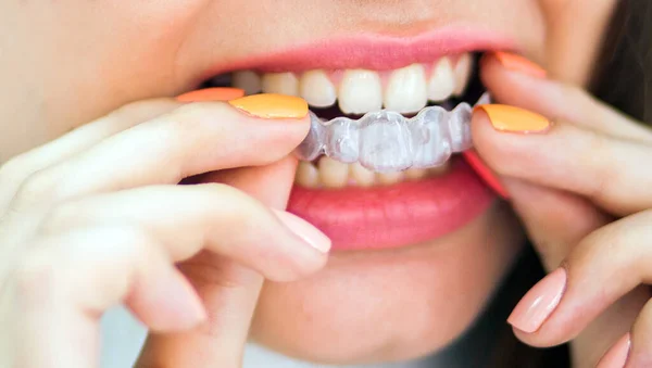 Woman Wearing Orthodontic Silicone Trainer Invisible Braces Aligner — Stock Photo, Image