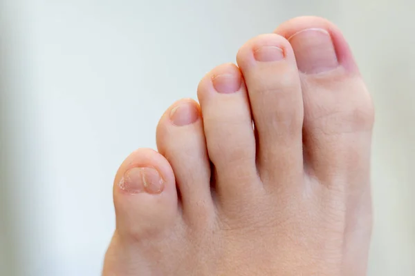Closeup of Female feet with big double little toe — Stock Photo, Image