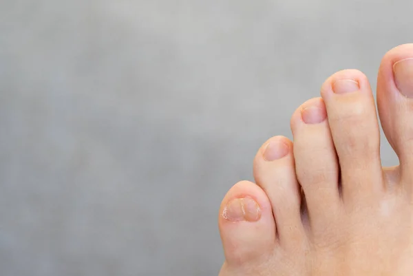 Pés femininos com grande dedo do pé duplo no fundo cinza — Fotografia de Stock