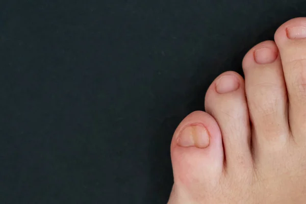 Pés femininos com grande dedo do pé duplo no fundo preto — Fotografia de Stock