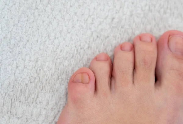 Kvinnliga fötter med stor dubbel liten tå på grå bakgrund — Stockfoto