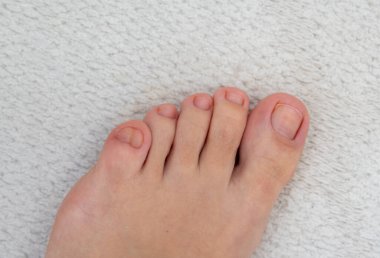 Gri arka planda büyük, çift ayak parmağı olan kadın ayakları.