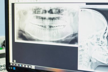 Diş hekimi aramak için mornitor içinde insan çenesinin X-ray 'i.