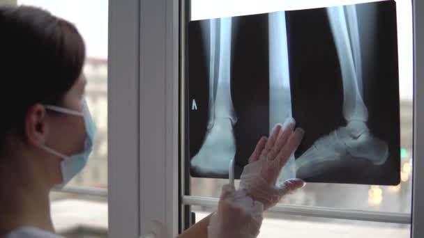 Läkaren undersöker röntgenfilm av brutet ben — Stockvideo