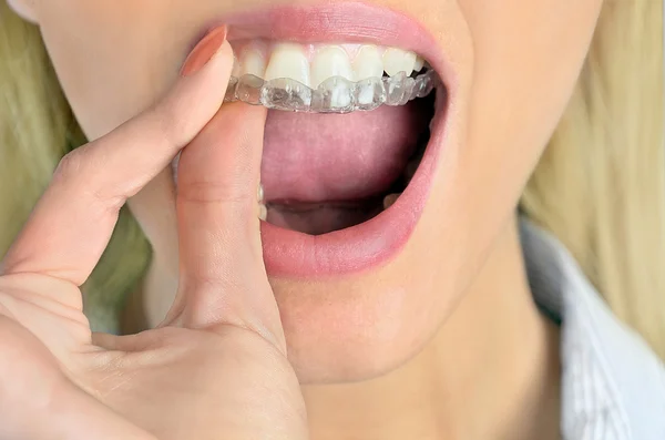 Woman with mouthguard — Stock Photo, Image