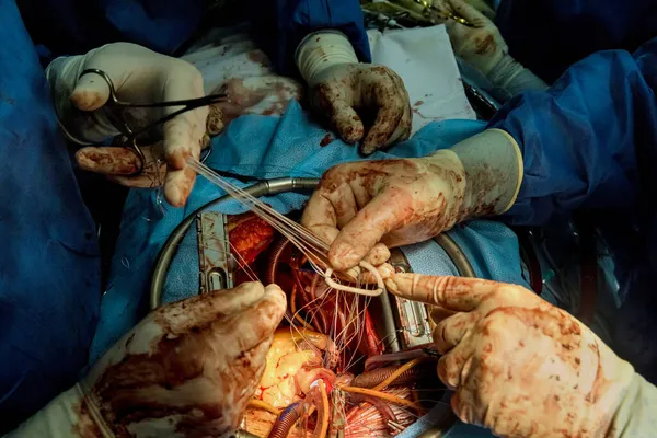 Los Médicos Realizan Cirugía Operación Reemplazo Válvula Mitral Corazón Abierto — Foto de Stock