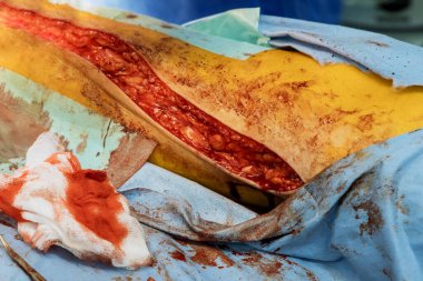 Cerrahlarla ayak ameliyatı. Ameliyat odasında hastanın bacağı üzerinde çalışıyoruz..