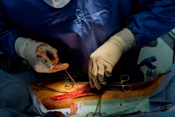 Foot Surgery Surgeons Team Working Leg Patient Operating Room — Stock Photo, Image