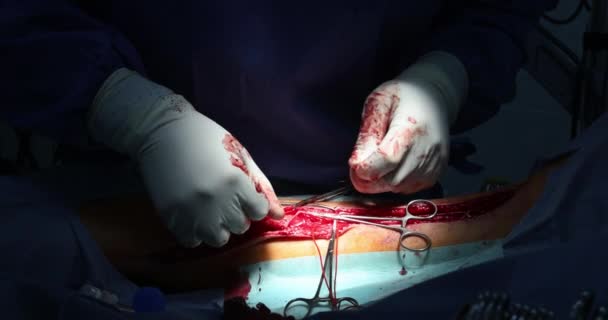 Operation surgical treatment on leg using different surgical tools during the operation — Stock Video