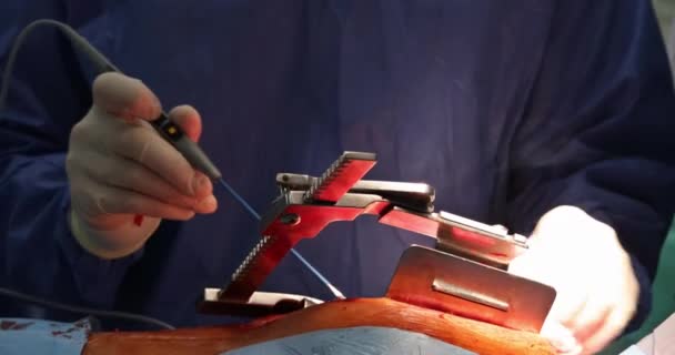CloseUp hartchirurg operatie hartchirurgie interventie close-up vervang klep open navelchirurgie minimaal invasieve chirurgie — Stockvideo