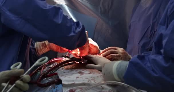 Equipe de cirurgiões em cirurgia cardíaca aberta hospitalar — Vídeo de Stock