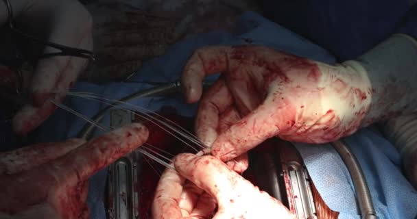 CloseUp heart surgeon doctor operation heart surgery intervention close-up replace valve open cord surgery minimally invasive surgery — Stock Video