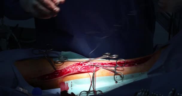 Equipo de cirujanos trabajando con la pierna del paciente en quirófano — Vídeo de stock