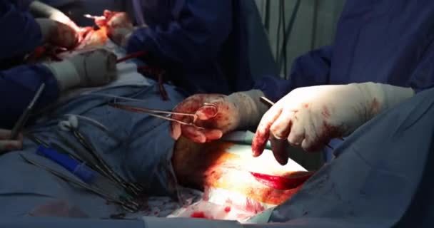 Surgeon making surgery of hospital in operating room with open wounds on leg — Stock Video