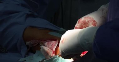 Cerrah ameliyattan sonra bacağındaki yarayı dikmeye başlar.