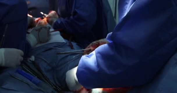 医院手术室内开放性腿伤的外科治疗 — 图库视频影像
