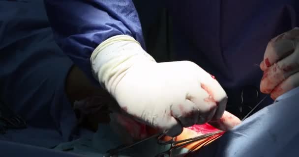 Открыть раны ног с помощью инструмента во время операции — стоковое видео