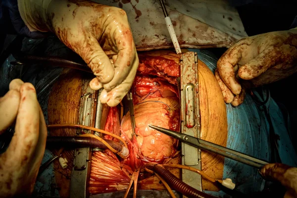 Team Replaces Valve Open Surgery Invasive Surgeons Operating Wearing Heart — Stockfoto