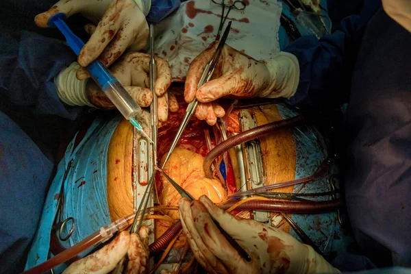 Durante Cirugía Las Manos Del Médico Corazón Abierto Operación Cirujanos — Foto de Stock