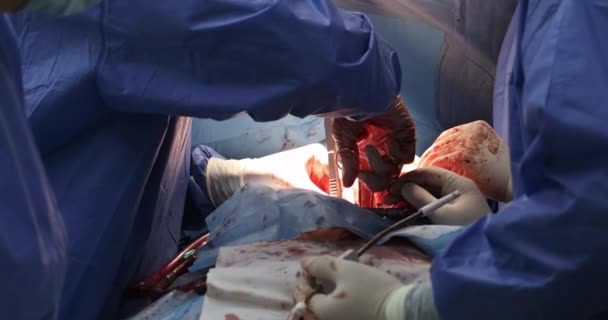 Team of surgeons operating wearing heart surgery intervention close-up replaces valve open surgery minimally invasive, surgeon — Stock Video