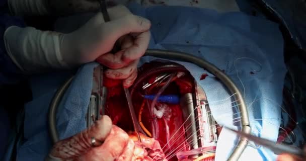 Primer plano de implantación de una válvula cardíaca biológica cirugía cardiovascular cirugía a corazón abierto — Vídeo de stock