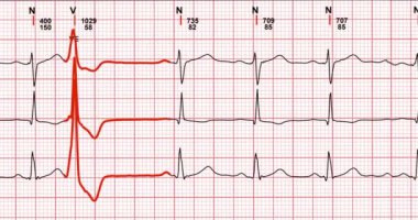Kalp çizgisi eğimli elektrokardiyogram EKG tıbbi muayeneyi hızlandırır