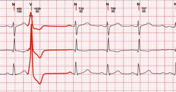 Eletrocardiograma ECG com curvas de linha cardíaca exame médico — Vídeo de Stock