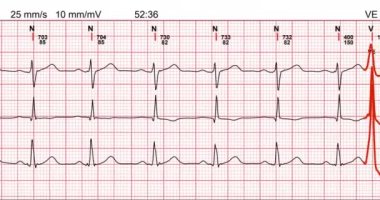 Elektrokardiyogram, EKG 'den gelen dalga formu test sonucunu gösteriyor.