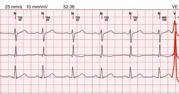 Electrocardiograma, forma de undă de la EKG care prezintă testul de examinare — Videoclip de stoc