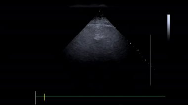 3D kardiyak ultrason cihazının ekokardiyografi görüşü paciente
