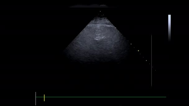 Μια Οθόνη Του Μηχάνημα Υπερήχων Υπερηχοκαρδιογράφημα Άποψη Paciente — Αρχείο Βίντεο