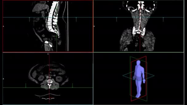 Томографія Мрт Дані Діагностики Лабораторному Екрані Дослідженням Хвороб Людини — стокове відео