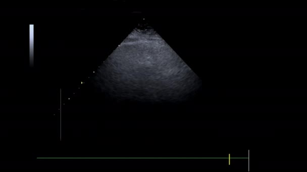 Echocardiogram Hartonderzoek Van Echografie Van Het Bed — Stockvideo